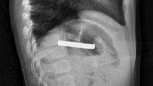 bogazindan 19 adet miknatis cikartildi OZEPcWz8