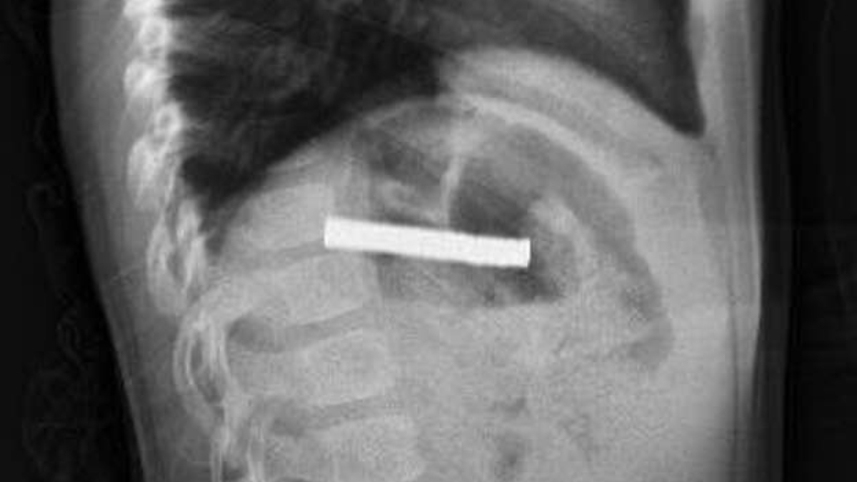 elazigda cocugun bogazindan 19 adet miknatis cikartildi gJc4jN1q